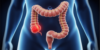 Câncer intestinal antes dos 50: a verdade que ninguém quer ouvir