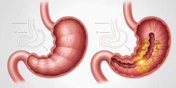 Úlcera Estomacal: Uma Condição Que Pode Levar à Cirurgia