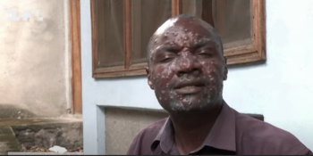 A Luta Contra o Mpox: OMS Aprova Primeira Vacina e Expande Distribuição 